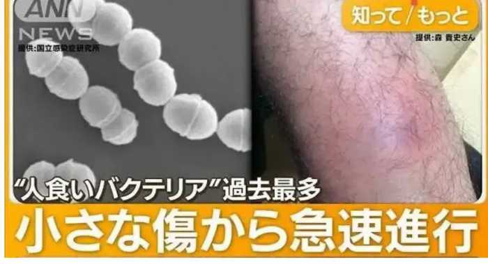 日本“食人菌”爆发，已有上千人被感染，传播速度非常快